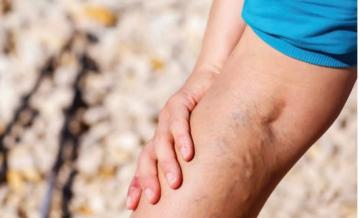 homeopathy for varicose veins homeopathy for varicose veins
